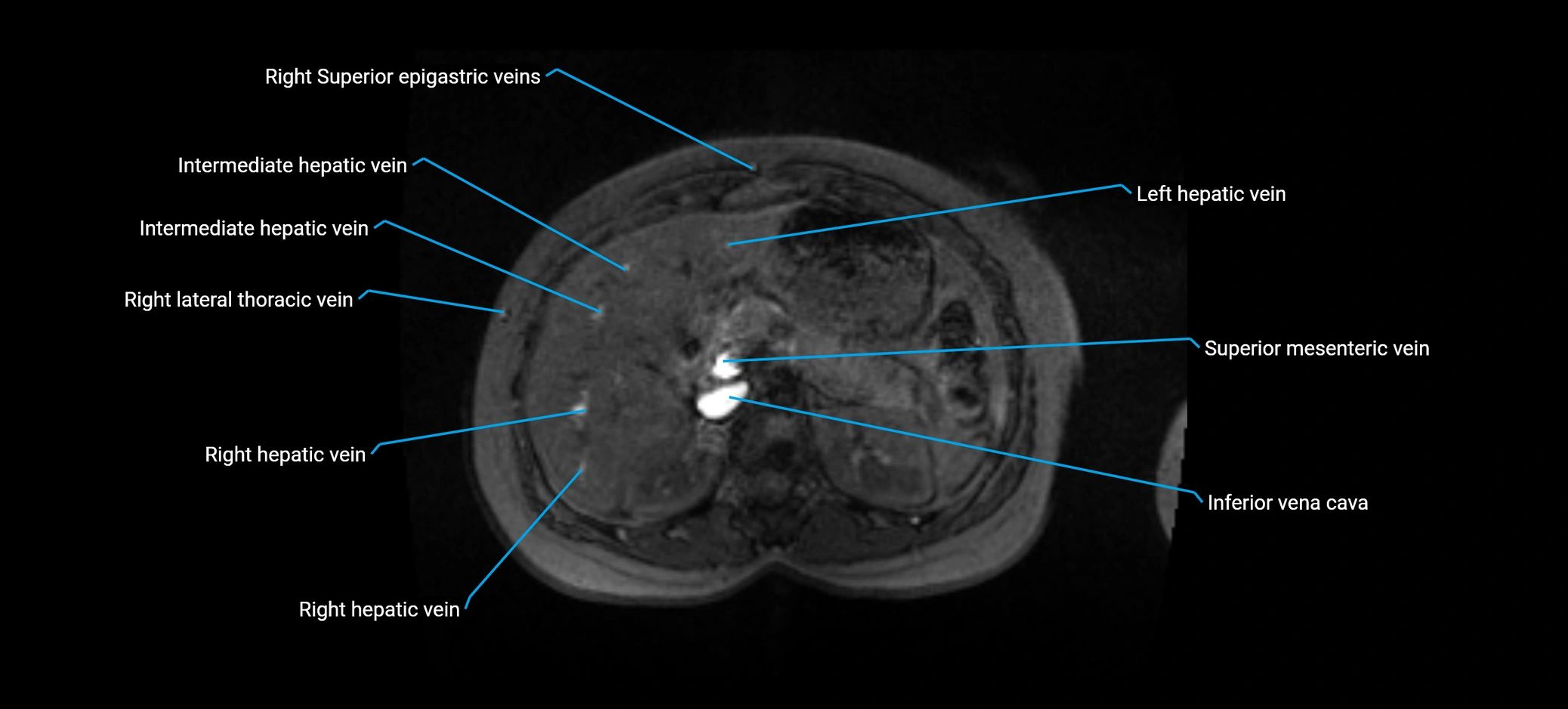 MRV abdomen pelvis & lower limb axial cross sectional anatomy labelled MRI image 51 (1).webp